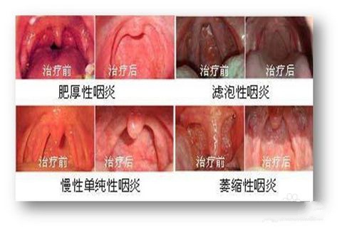 五大慢性咽炎类型 对照下自己是哪种类型?