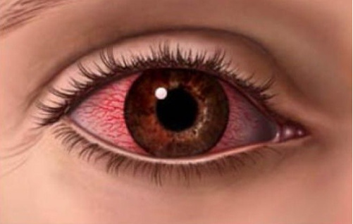 眼球充血是什么原因导致的?该如何治疗眼球充